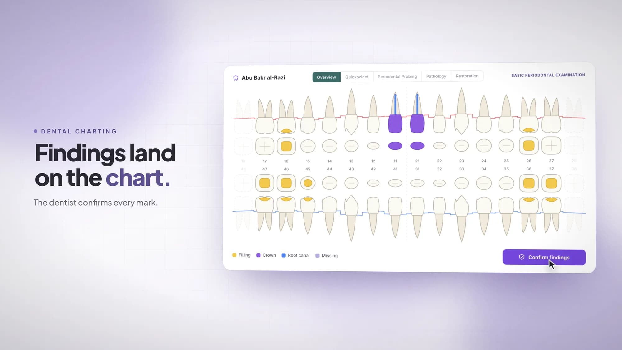 A patient's tooth chart in ClinicOS, with fillings, crowns and root canals marked by colour on numbered teeth, and a Confirm findings button. Beside it, the words "Findings land on the chart. The dentist confirms every mark."
