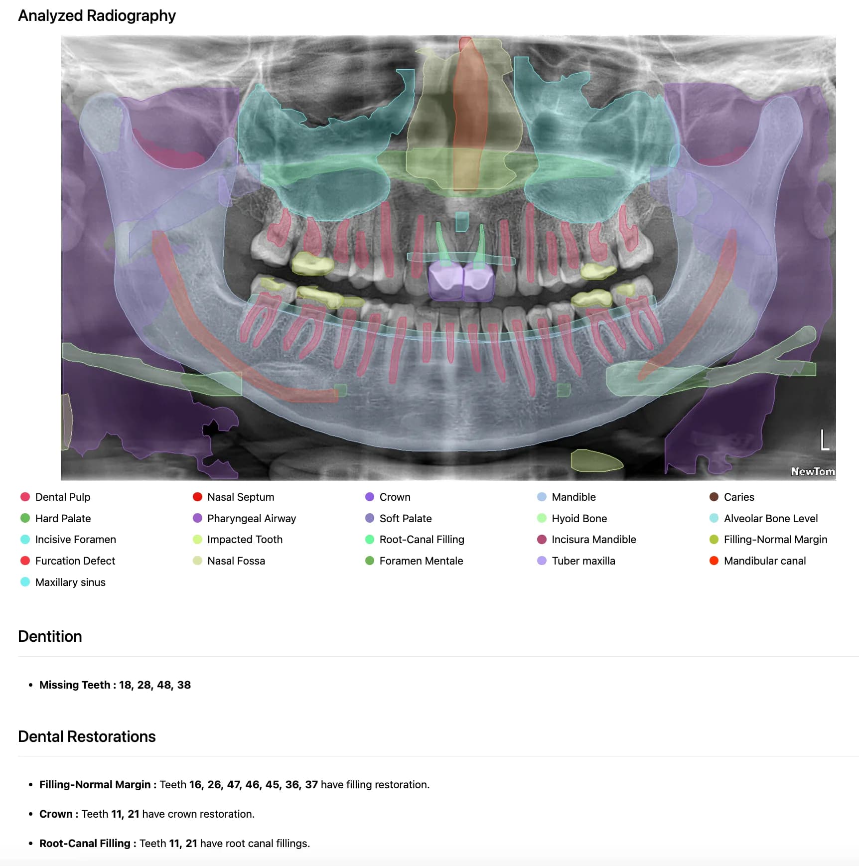 Dental IQ patient report: the analysed panoramic X-ray with a colour legend, followed by plain-language sections on the dentition and dental restorations.