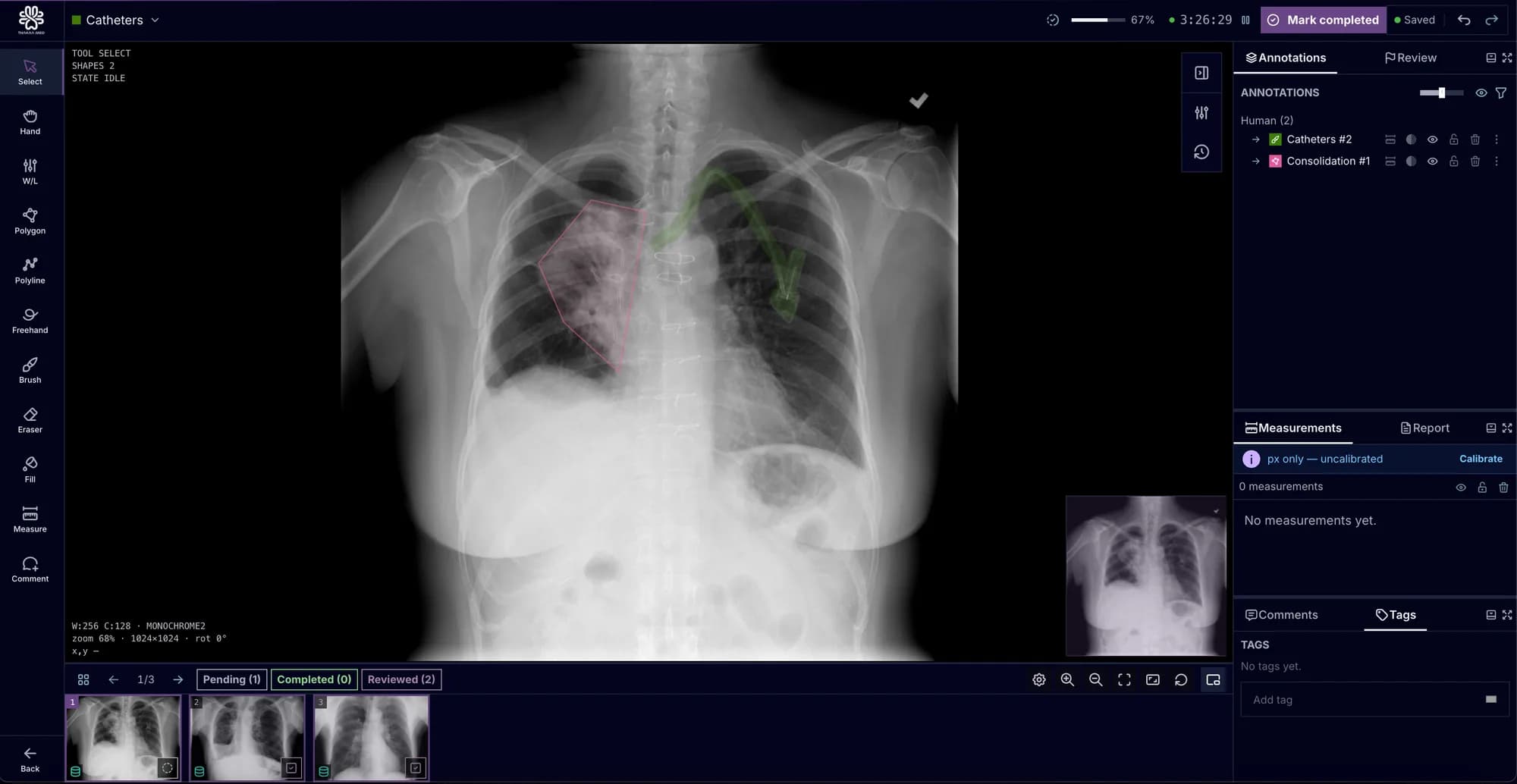 SAIF annotation workspace: a radiograph with a polygon and a line annotation, drawing tools down the left, and annotation, measurement and comment panels on the right.